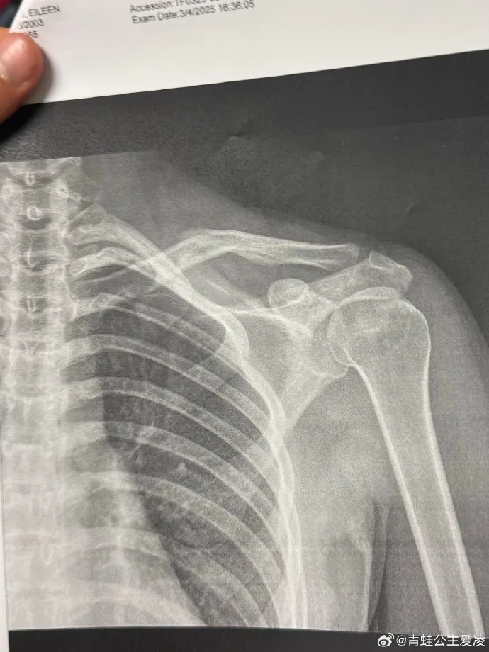 bt, 手在该项目 bt, 手在该项目